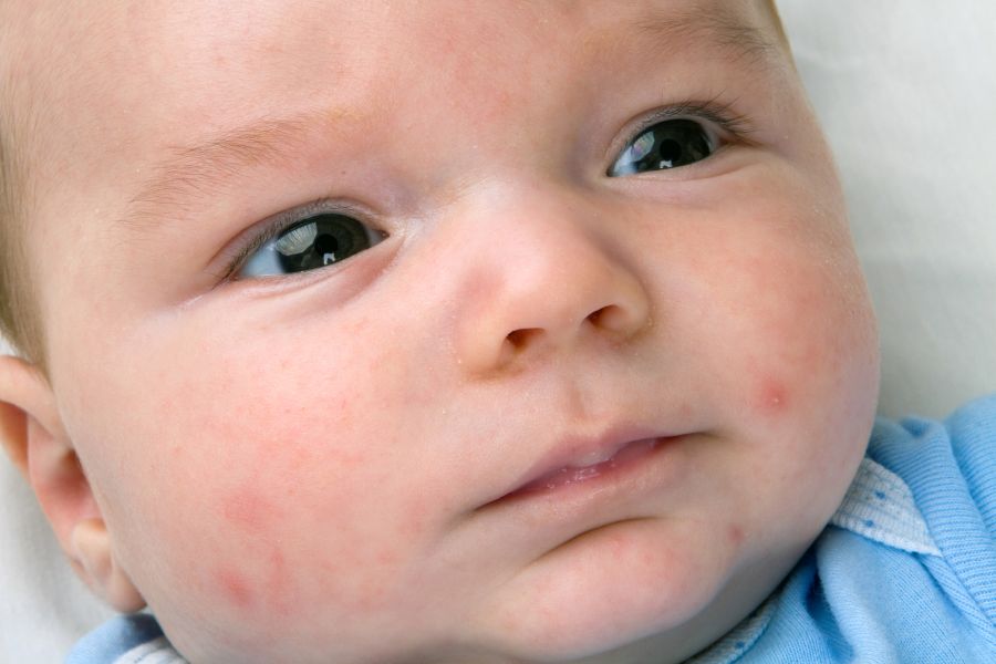 infant acne
